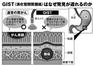 間質性がん